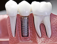 Norcross, GA Denitst - Dental Implants